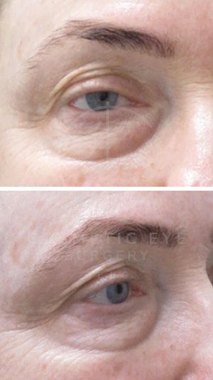 Upper and Lower Eyelid Surgery & Full Face CO₂ LASER Resurfacing Patient Image #5