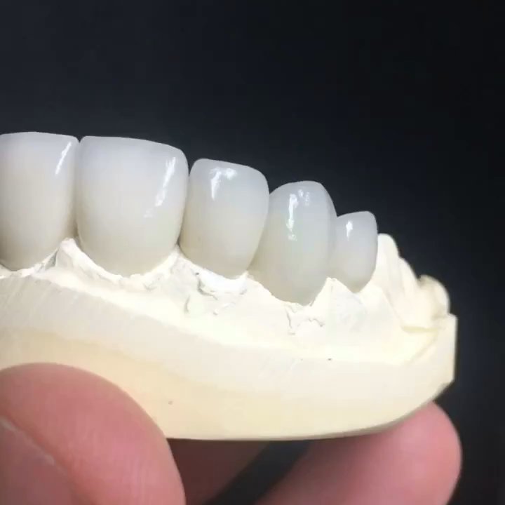 Frank Pastore, DDS - Smile Makeover using all ceramic porcelain crowns. Dr. Pastore uses only the finest Dental labs to make our natural looking restorations. - Cosmetic Dentists Near Me - Menifee, California