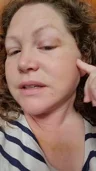 @lilyofthevalley6150, day 14 after mini facelift and chin liposuction