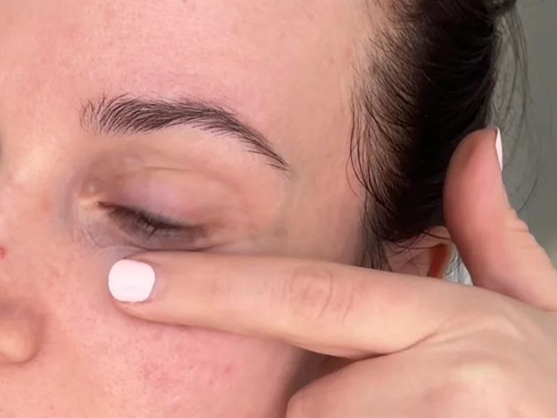 Micro-needling patches