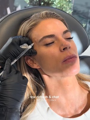 Botox result at Utah Facial Plastics & UFP Hair Restoration