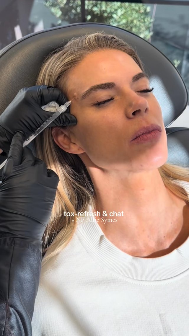 Botox result at Utah Facial Plastics & UFP Hair Restoration