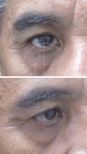 Lower Eyelid Ectropion Repair & Upper Eyelid Blepharoplasty  Patient Image #2