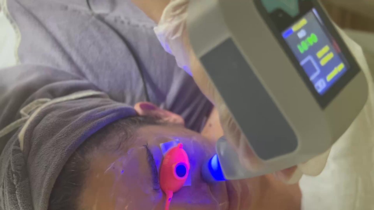 Moon Lake Spa - Collagen gun treatment - Reflexology Near Me - Vienna, Virginia