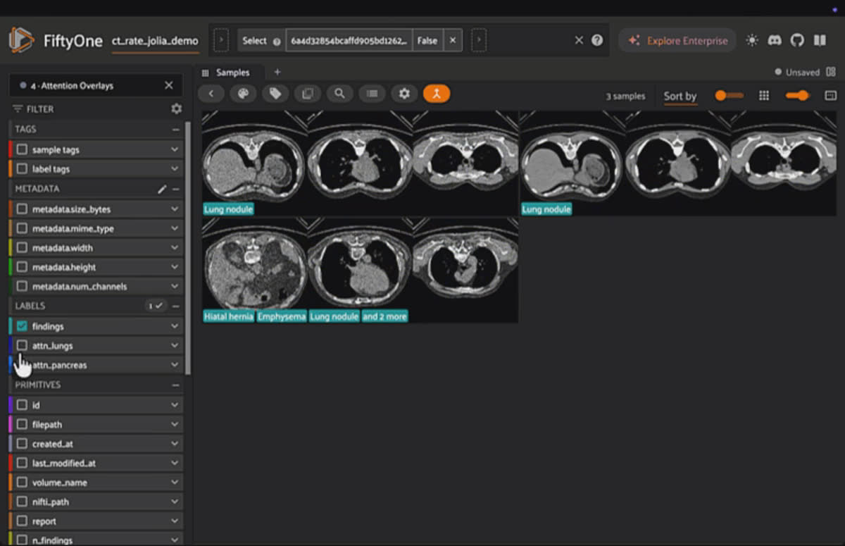Attention Overlays in full-screen mode: organ saliency heatmaps rendered on the CT scan for Jolia's lung and pancreas concept queries.