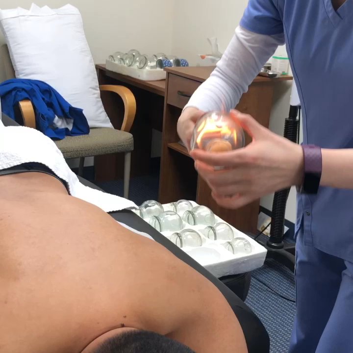 AHMC WELLNESS CENTER - Cupping therapy for back pain  Soothing treatment to release muscle tension - Acupuncture Near Me - Alhambra, California