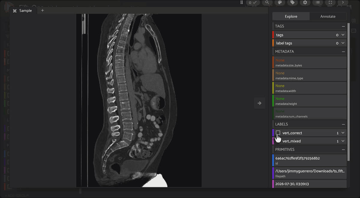 FiftyOne sagittal spine views with vertebrae colored by ordered label, exposing an L2 versus L3 mix-up as a broken color sequence.