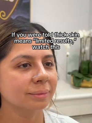 Rhinoplasty result at Eos Rejuvenation