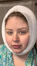 @samantha_roseeeee on the day of a neck lift