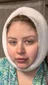 @samantha_roseeeee on the day of a neck lift