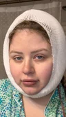 @samantha_roseeeee on the day of a neck lift