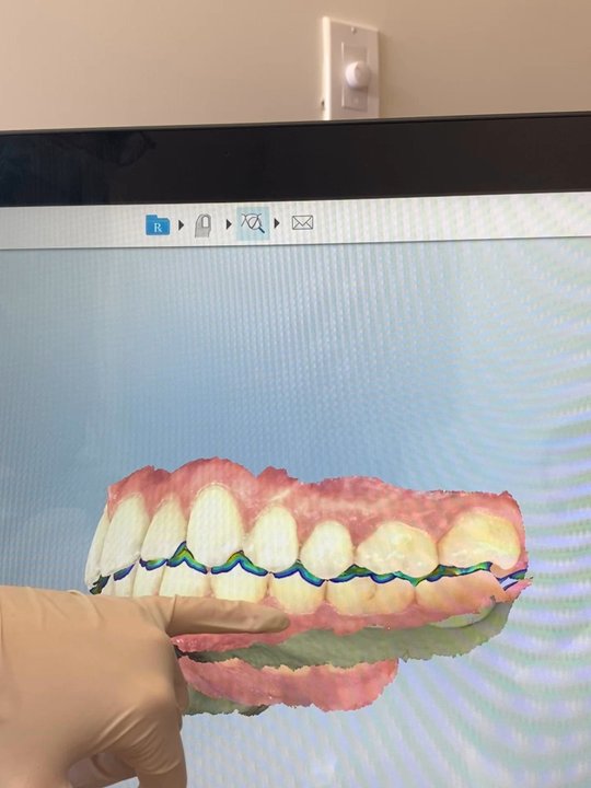 Skyline Dental - Cool gadget that shows the Corrosion on my teeth from grinding - General Dentistry Near Me - Springfield, New Jersey