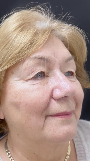 Upper Eyelid Blepharoplasty Patient Image #1