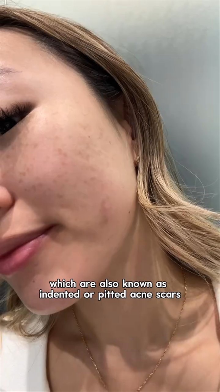 Stella M22 Laser · Scar Filler (Benjamin Clinic)