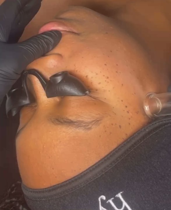 Blissful Zen Day Spa - Hydrafacial with Derma Planning - Massage Near Me - Mansfield, Texas