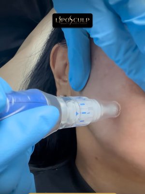 Microneedling result at LipoSculp