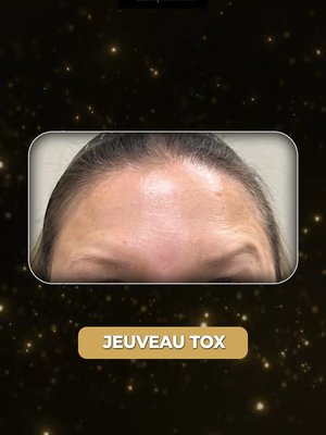 Liposuction result at LipoSculp