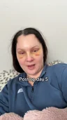 @sabrinaaa0830, day 5 after an endoscopic brow lift with upper eyelid surgery