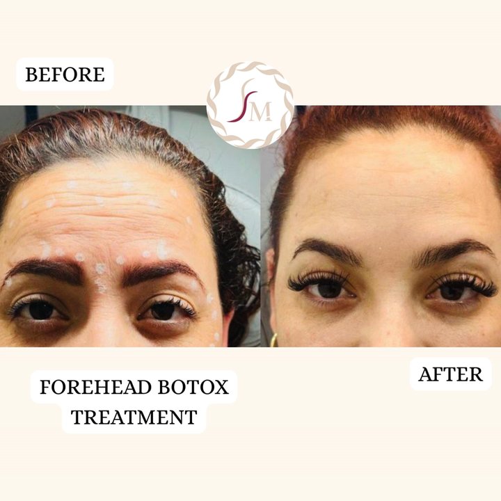 Facial Mania - Valentine's glow starts with you  Treat your forehead to a smooth, refreshed look just in time for date night or self love season. - Skin Care Near Me - Irving, Texas