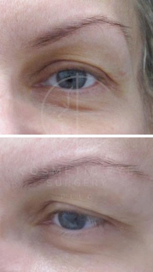 Upper Eyelid Blepharoplasty Patient Image #1