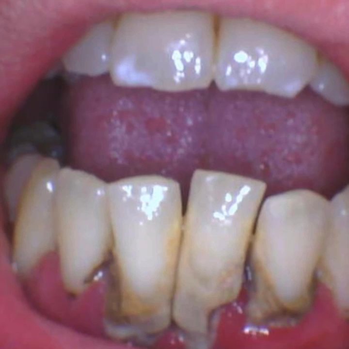 Midtown Dental Studio - Smile transformation - General Dentistry Near Me - Plantation, Florida