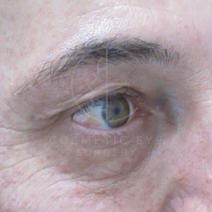 Upper Eyelid Surgery for Men  Patient Image #1