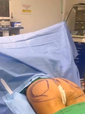 Lip Filler result at Ourian Plastic Surgery