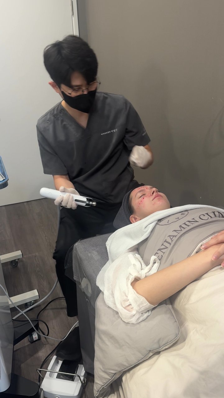 RF Microneedling (Benjamin Clinic)